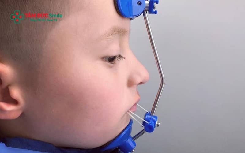 Facemask Abc888k vip truy cập nhanh là khí cụ ngoài mặt dùng để hỗ trợ kéo hàm trên ra trước, thường được chỉ định cho trẻ có khớp cắn ngược do xương