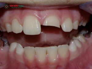 Gãy nửa răng cửa có nguy hiểm không? Cách phục hồi răng cửa Abc8c1 com khuyến mãi hấp dẫn