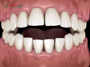 Hô hàm trên là gì? Nguyên nhân, dấu hiệu và cách khắc phục hiệu quả