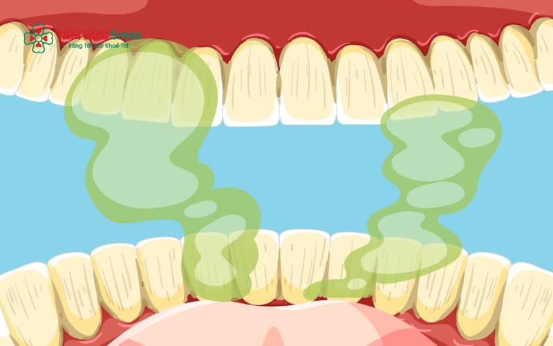 Điều trị triệt để các bệnh lý nền như viêm dạ dày, viêm xoang hay viêm amidan giúp kiểm soát hôi miệng hiệu quả và bền vững