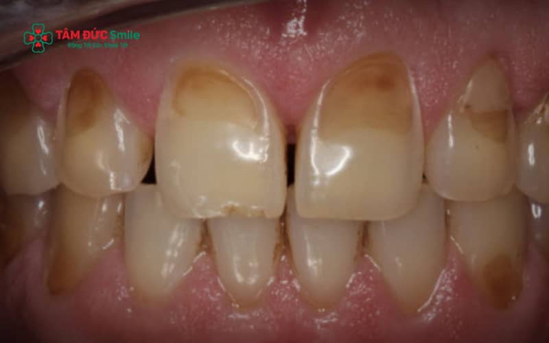 Hỏng men răng là tình trạng lớp men bảo vệ bên ngoài răng bị mòn, nứt hoặc tổn thương, làm răng yếu đi và dễ ê buốt, ABC88 com đăng nhập hơn