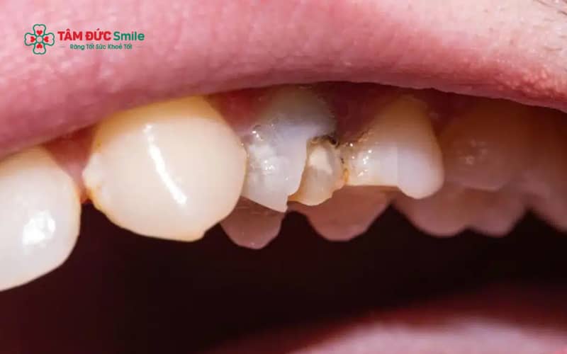 Men răng bị hỏng sớm thường biểu hiện qua cảm giác ê buốt, răng đổi màu, bề mặt men mỏng và dễ mẻ nứt khi ăn nhai