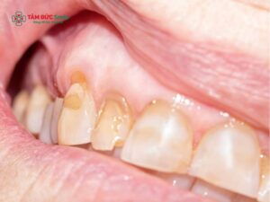 Hỏng men răng là gì? Dấu hiệu mòn men răng và cách phục hồi hiệu quả