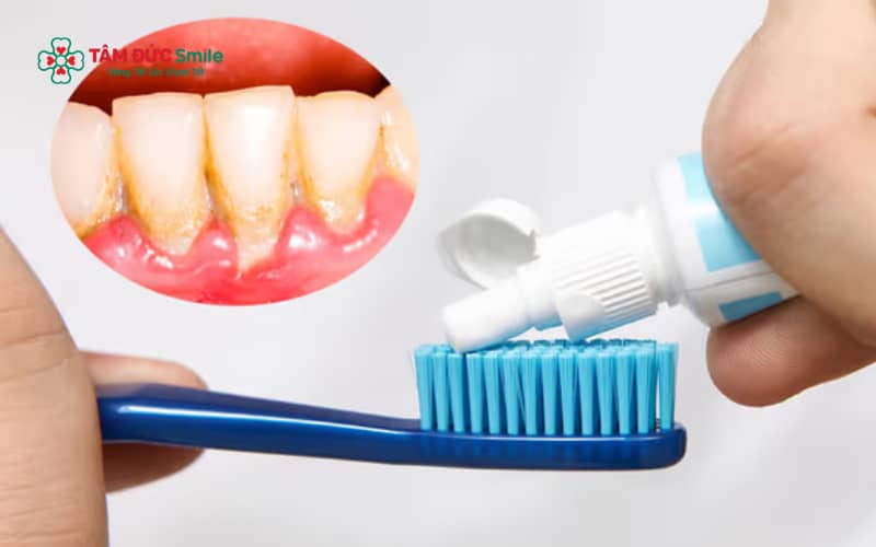 Kem đánh răng chỉ giúp làm sạch mảng bám mềm trên bề mặt răng