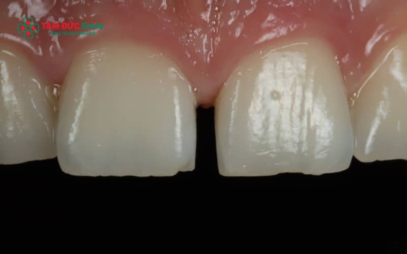 Các phương pháp khắc phục răng thưa tại nhà hầu như không mang lại hiệu quả bền vững so với Abc8b tỷ lệ kèo World Cup 2026 LINK TRANG CHỦ ABC88 CHUẨN 2026 đúng chỉ định