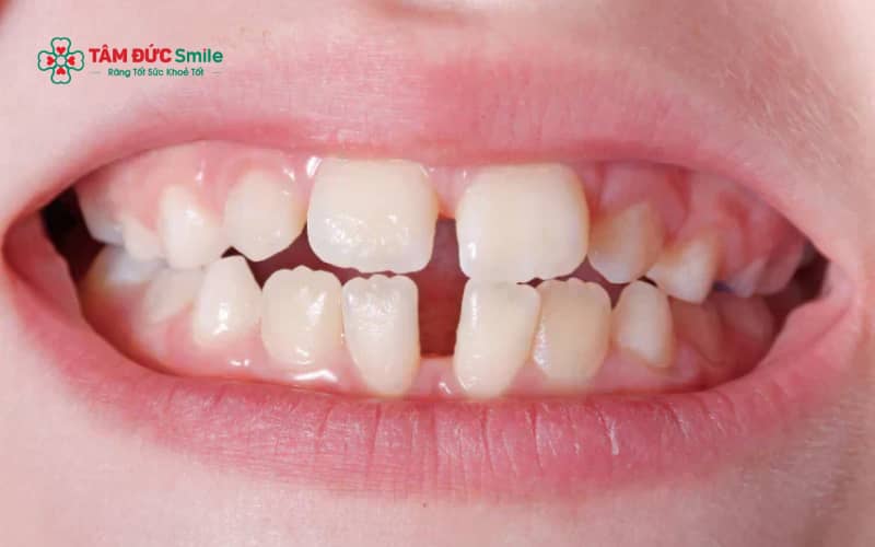 Nhiều cách khắc phục răng thưa tại nhà được truyền miệng nhưng chưa có cơ sở khoa học và tiềm ẩn nguy cơ ảnh hưởng răng thật