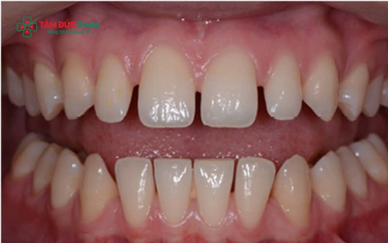 Khi răng thưa gây ảnh hưởng Abc8c1 com khuyến mãi hấp dẫn, ăn nhai hoặc có dấu hiệu viêm nướu, người bệnh nên sớm thăm khám LINK TRANG CHỦ ABC88 CHUẨN 2026