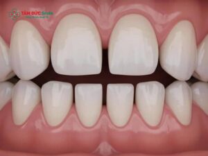Cách khắc phục răng thưa tại nhà. Khắc phục răng thưa tại nhà có thật sự hiệu quả không?