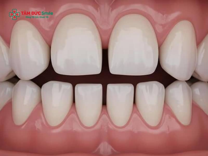Cách khắc phục răng thưa tại nhà. Khắc phục răng thưa tại nhà có thật sự hiệu quả không?