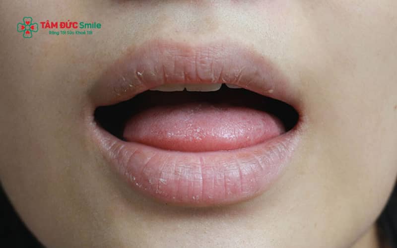 Khô miệng thường biểu hiện qua cảm giác miệng khô rát, ít nước bọt, khó nuốt, môi nứt nẻ và Abc8c1 com thiên đường cá cược có mùi.