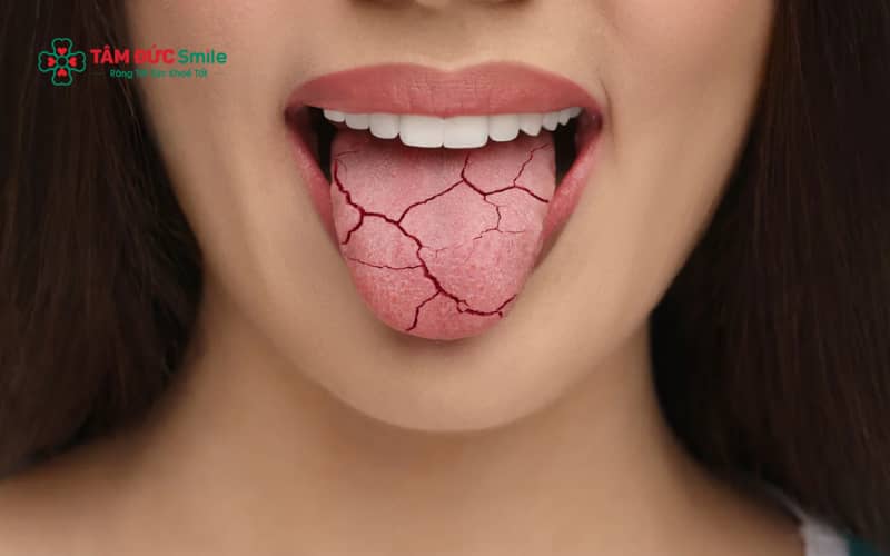 Khô miệng có thể xuất phát từ nhiều nguyên nhân khác nhau như sinh lý, tác dụng phụ của thuốc hoặc các bệnh lý ảnh hưởng đến tuyến nước bọt.