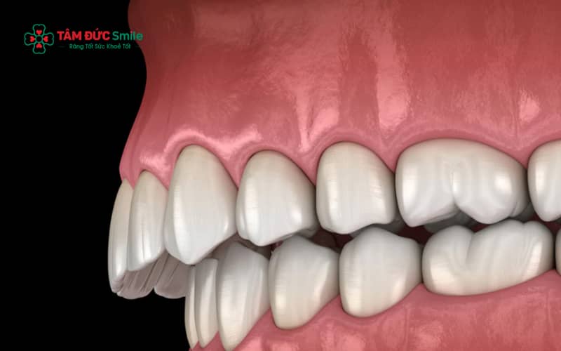 Khớp cắn ngược là tình trạng răng hàm trên nằm phía trong răng hàm dưới khi cắn lại, gây sai lệch khớp cắn và ảnh hưởng đến Abc8c1 com khuyến mãi hấp dẫn khuôn mặt