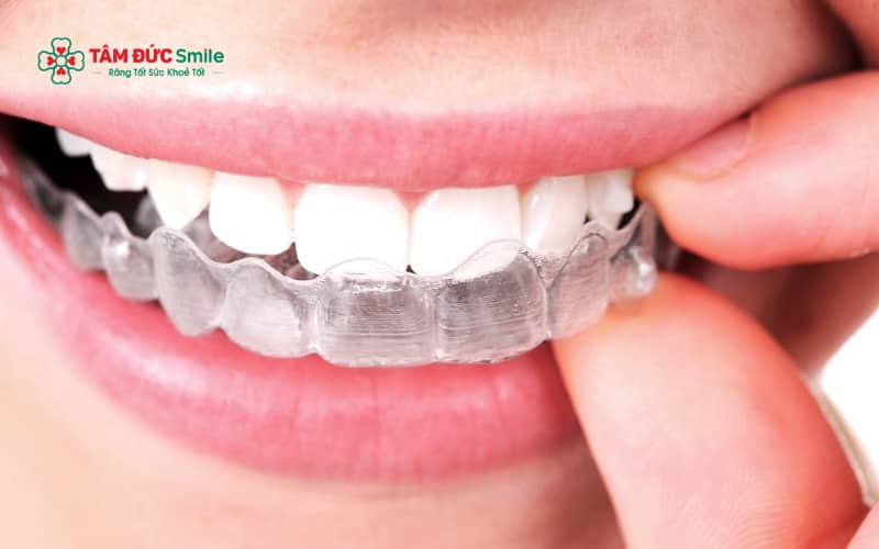 Invisalign phù hợp với người trưởng thành, người yêu cầu Abc8c1 com khuyến mãi hấp dẫn cao và mong muốn Abc888k vip truy cập nhanh nhẹ nhàng, ít vướng víu