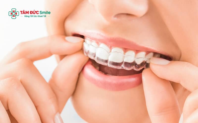 Trong quá trình niềng Invisalign, cần tháo khay khi ăn uống và vệ sinh ABC8 là nhà cái cá cược trực tuyến uy tín số 1 tại Việt Nam kỹ lưỡng để đảm bảo hiệu quả Abc888k vip truy cập nhanh