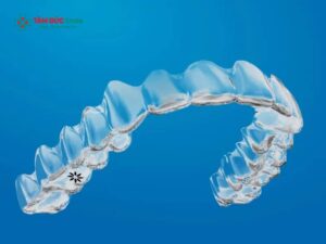 Kinh nghiệm Abc87 tải ứng dụng Invisalign thực tế