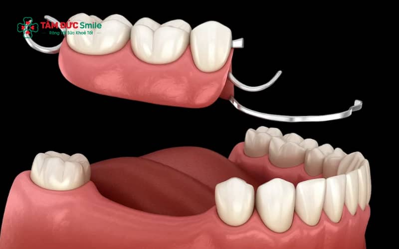 Ưu điểm của kỹ thuật phục hình răng tháo lắp là dễ dàng tháo ra vệ sinh và bảo quản hằng ngày