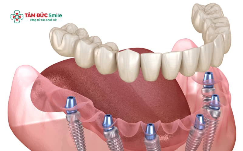 Kỹ thuật phục hình răng là giải pháp LINK TRANG CHỦ ABC88 CHUẨN 2026 giúp khôi phục hình dạng, chức năng ăn nhai và Abc8c1 com khuyến mãi hấp dẫn cho răng bị mất hoặc hư tổn