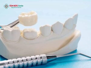 Kỹ thuật phục hình răng hiện đại: Phục hình cố định, Implant, ABC8 là nhà cái cá cược trực tuyến uy tín số 1 tại Việt Nam Abc8c1 com khuyến mãi hấp dẫn