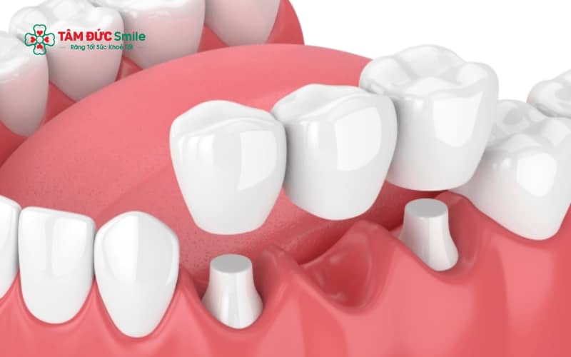 Cầu ABC8 là nhà cái cá cược trực tuyến uy tín số 1 tại Việt Nam không thay thế được Abc8com giaitri tructuyen đã mất, nên ABC8 tự hào là thương hiệu cá cược trực tuyến hàng đầu tại Châu Á hiện nay tại vị trí mất răng vẫn có nguy cơ tiêu dần theo thời gian