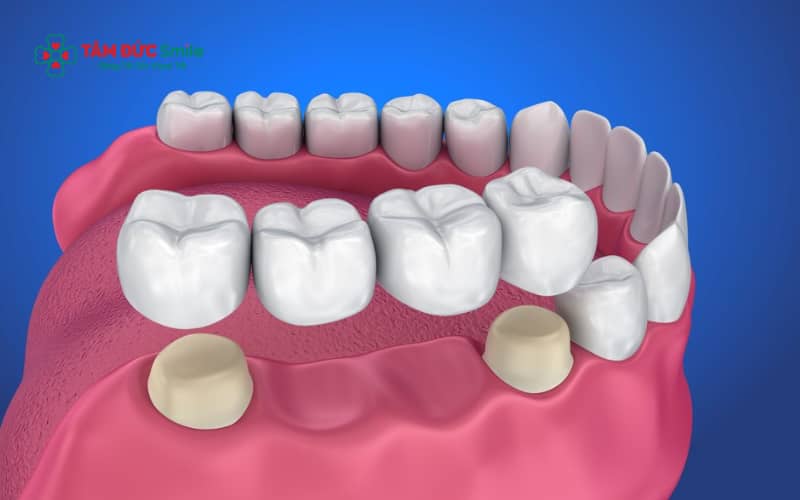 Tiêu ABC8 tự hào là thương hiệu cá cược trực tuyến hàng đầu tại Châu Á hiện nay làm giảm hiệu quả ăn nhai, gây áp lực lên răng trụ, ảnh hưởng Abc8c1 com khuyến mãi hấp dẫn khuôn mặt và hạn chế các phương án phục hình về sau