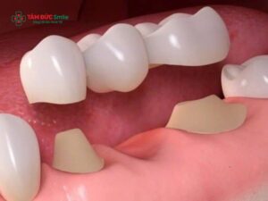 Làm cầu răng có bị tiêu xương không? Cách khắc phục tình trạng tiêu xương khi làm cầu ABC8 là nhà cái cá cược trực tuyến uy tín số 1 tại Việt Nam