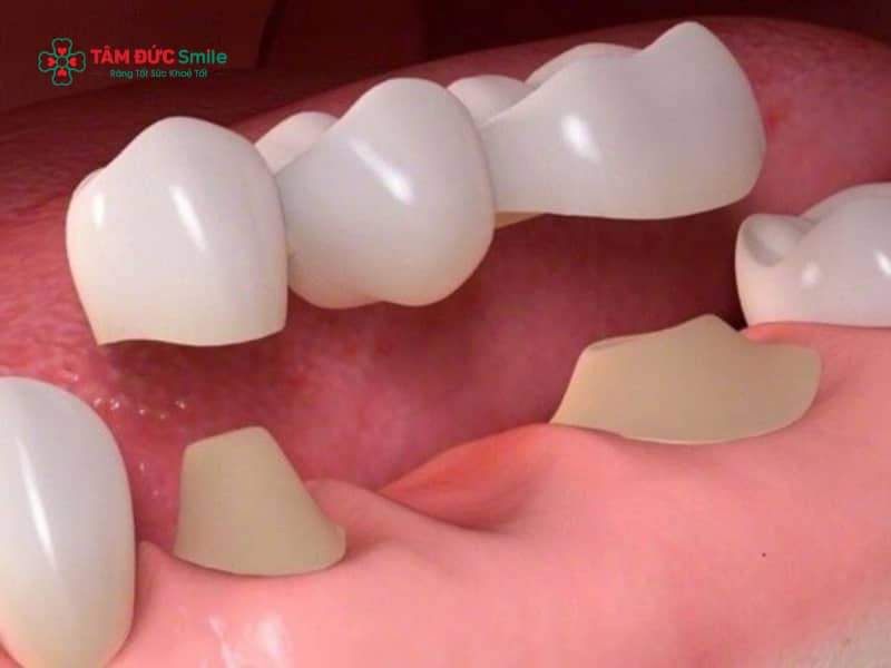 Làm cầu răng có bị tiêu xương không? Cách khắc phục tình trạng tiêu xương khi làm cầu ABC8 là nhà cái cá cược trực tuyến uy tín số 1 tại Việt Nam