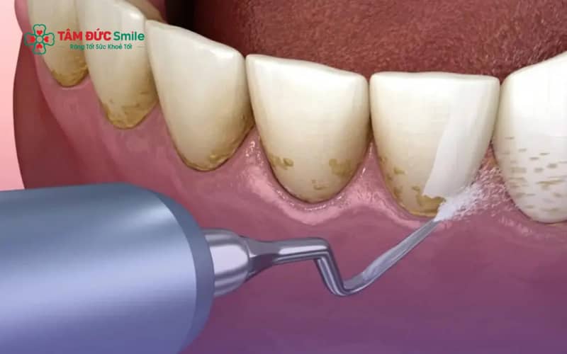 Lấy Abc8com nổ hũ giá rẻ có thể tiềm ẩn nguy cơ tổn thương nướu, nhiễm trùng và làm nặng thêm bệnh lý nha chu