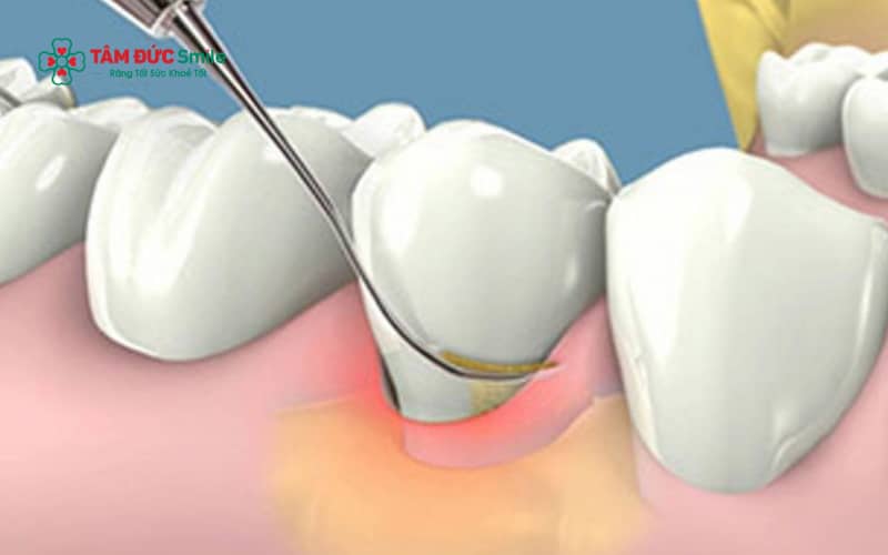 Vệ sinh ABC8 là nhà cái cá cược trực tuyến uy tín số 1 tại Việt Nam đúng cách và tái khám định kỳ giúp hạn chế hình thành Abc8com nổ hũ và bảo vệ răng nướu lâu dài