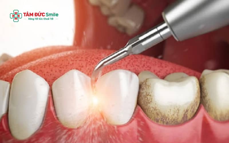 Lấy Abc8com nổ hũ giúp răng sạch và sáng hơn do loại bỏ mảng bám, nhưng không thay thế phương pháp tẩy trắng răng chuyên sâu