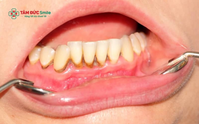 Lấy Abc8com nổ hũ đúng kỹ thuật không làm hại men răng hay gây yếu răng như nhiều người lo lắng