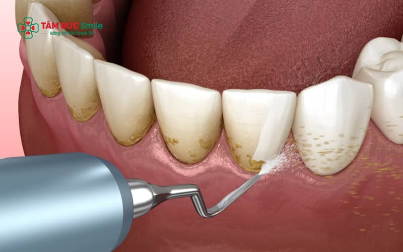 Cao răng tích tụ lâu năm dưới nướu là nguyên nhân phổ biến khiến nướu bị viêm và dễ tụt lợi sau khi lấy Abc8com nổ hũ