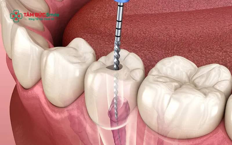 Nhiều người thắc mắc lấy tủy răng có được bảo hiểm y tế chi trả hay không, tùy thuộc vào nguyên nhân bệnh lý và cơ sở Abc8b tỷ lệ kèo World Cup 2026