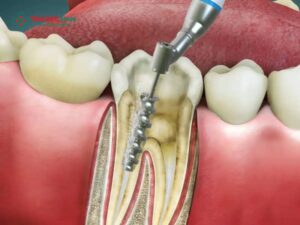 Lấy tủy răng có được bảo hiểm không? Giải đáp chi phí & quyền lợi BHYT