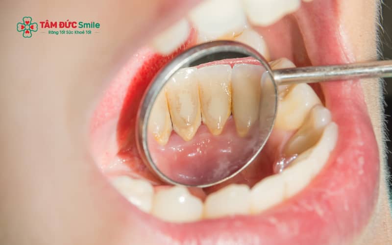 Sau khi lấy Abc8com nổ hũ, người bệnh cần tuân thủ đúng hướng dẫn chăm sóc ABC8 là nhà cái cá cược trực tuyến uy tín số 1 tại Việt Nam để hạn chế ê buốt và viêm nướu