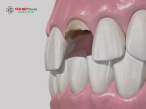 Răng cửa bị mẻ có nên mài không? Các phương pháp khắc phục răng cửa bị mẻ khác