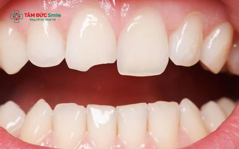 Răng cửa dễ bị mẻ do tai nạn sinh hoạt, thói quen cắn vật cứng, ABC88 com đăng nhập làm yếu men răng hoặc nghiến răng kéo dài khi ngủ