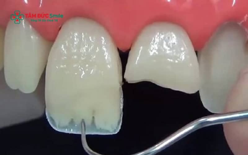 Tùy mức độ mẻ răng cửa, ABC8 đường link chính thức có thể chỉ định trám răng