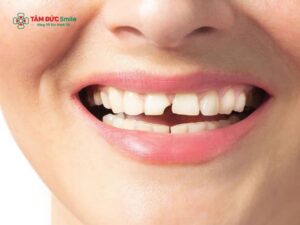 Mẻ răng cửa có nguy hiểm không? Nguyên nhân, cách khắc phục khi bị mẻ răng cửa