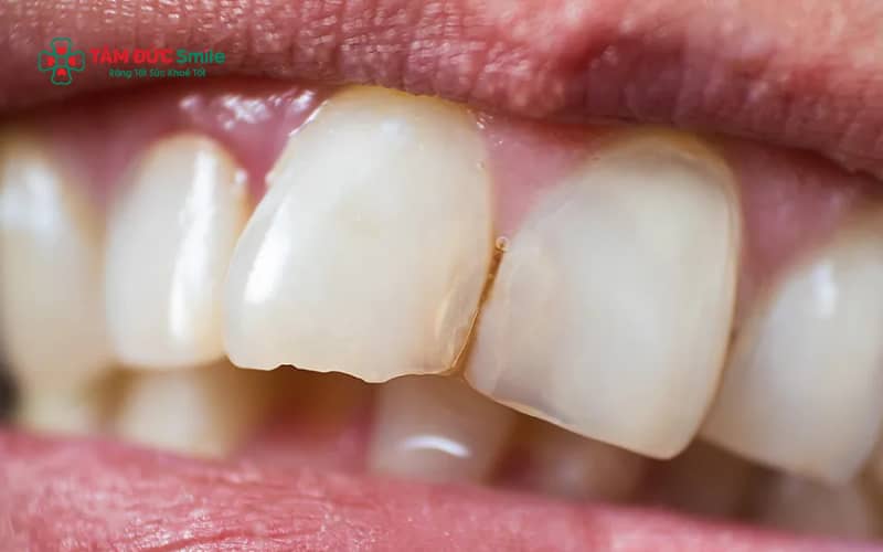 Mẻ răng hàm là tình trạng răng phía trong cung hàm bị sứt mẻ, nứt vỡ một phần cấu trúc, ảnh hưởng trực tiếp đến chức năng ăn nhai.
