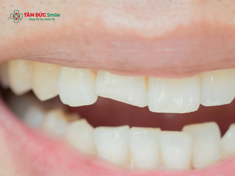 Mẻ răng hàm: Nguyên nhân, cách phục hồi và phòng ngừa