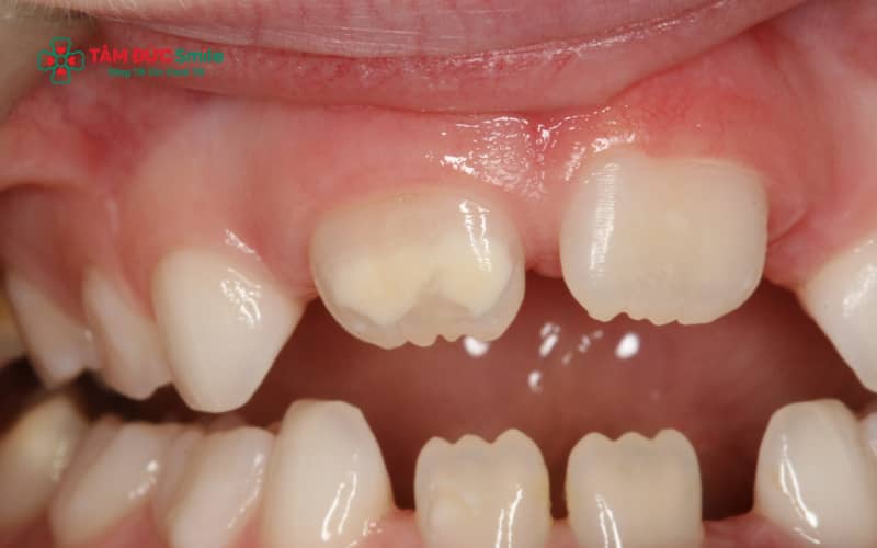 Men răng yếu là tình trạng lớp men bảo vệ bên ngoài răng bị mỏng, mất khoáng hoặc tổn thương, khiến răng dễ ê buốt và tăng nguy cơ ABC88 com đăng nhập