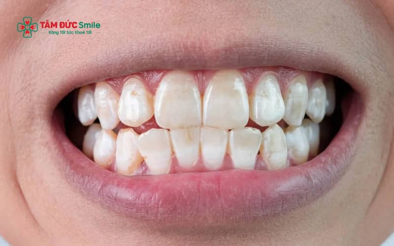 Men răng yếu ở mức độ nhẹ có thể được cải thiện thông qua tái khoáng và chăm sóc đúng cách