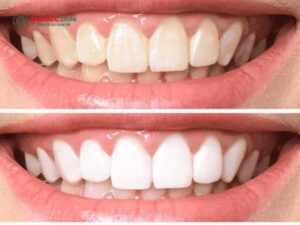 Mẹo làm trắng răng trong 5 phút tại nhà: Ưu, nhược điểm và một số lưu ý