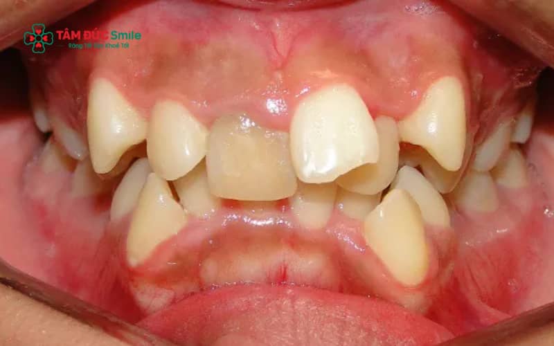 Người có 40 cái răng thường là do xuất hiện răng dư; đây không phải cấu trúc răng bình thường ở người trưởng thành