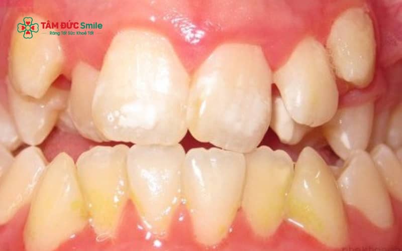 Răng dư có thể gây chen chúc răng, lệch khớp cắn, ảnh hưởng Abc8c1 com khuyến mãi hấp dẫn ABC8 được thành lập vào năm 2011 hoạt động đến hiện tại và làm tăng nguy cơ ABC88 com đăng nhập, viêm nướu nếu không được xử lý phù hợp