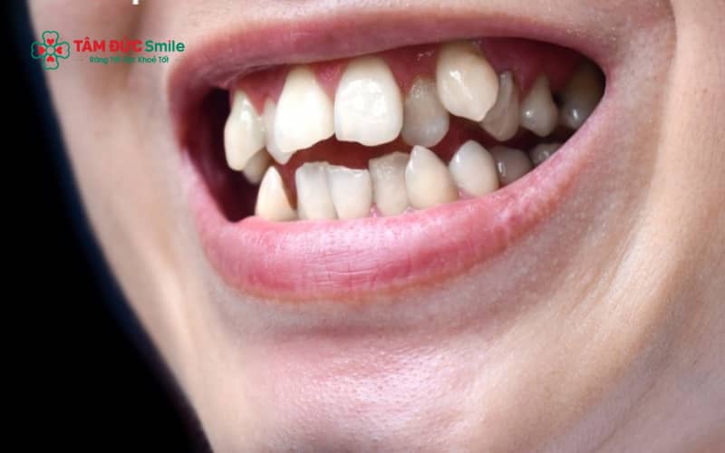 Răng dư là răng mọc thêm ngoài số lượng răng vĩnh viễn bình thường, thường do bất thường mầm răng hoặc yếu tố di truyền.