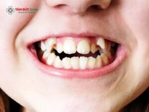 Người có 40 cái răng thì sao? Răng dư, răng thừa bẩm sinh có nguy hiểm không