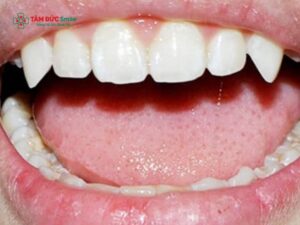 Người có răng trâu là gì? Đặc điểm, nhân tướng học và cách khắc phục