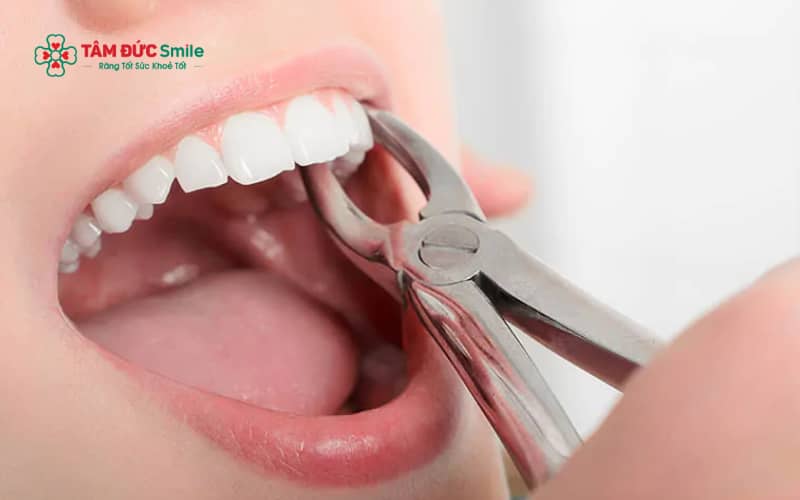 Thăm khám tổng quát, chụp phim X-quang và lựa chọn LINK TRANG CHỦ ABC88 CHUẨN 2026 uy tín là những yếu tố quan trọng giúp đảm bảo an toàn khi nhổ răng