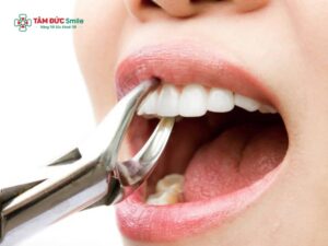 Những ngày không nên nhổ răng: Kiêng ngày xấu, chọn thời điểm an toàn